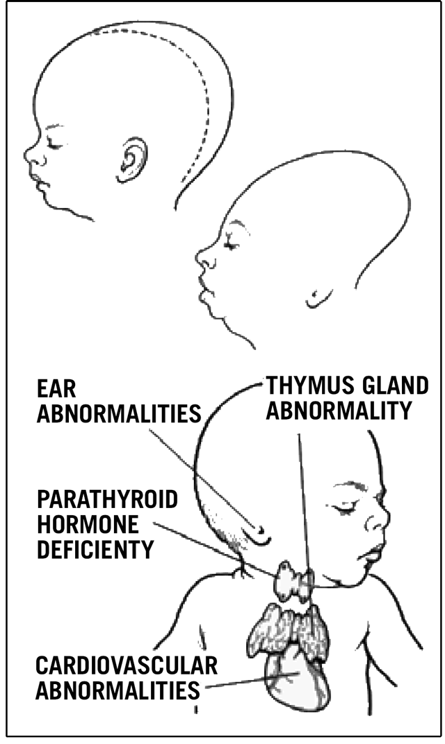 Illustration of very severe birth defects caused by Accutane: skull shape, small chin, enlarged skull, deformed or missing ears