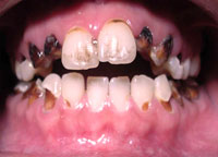 meth mouth: pus-streaked gums and blackened and broken rotting teeth is attributed to heavy methamphetamine use